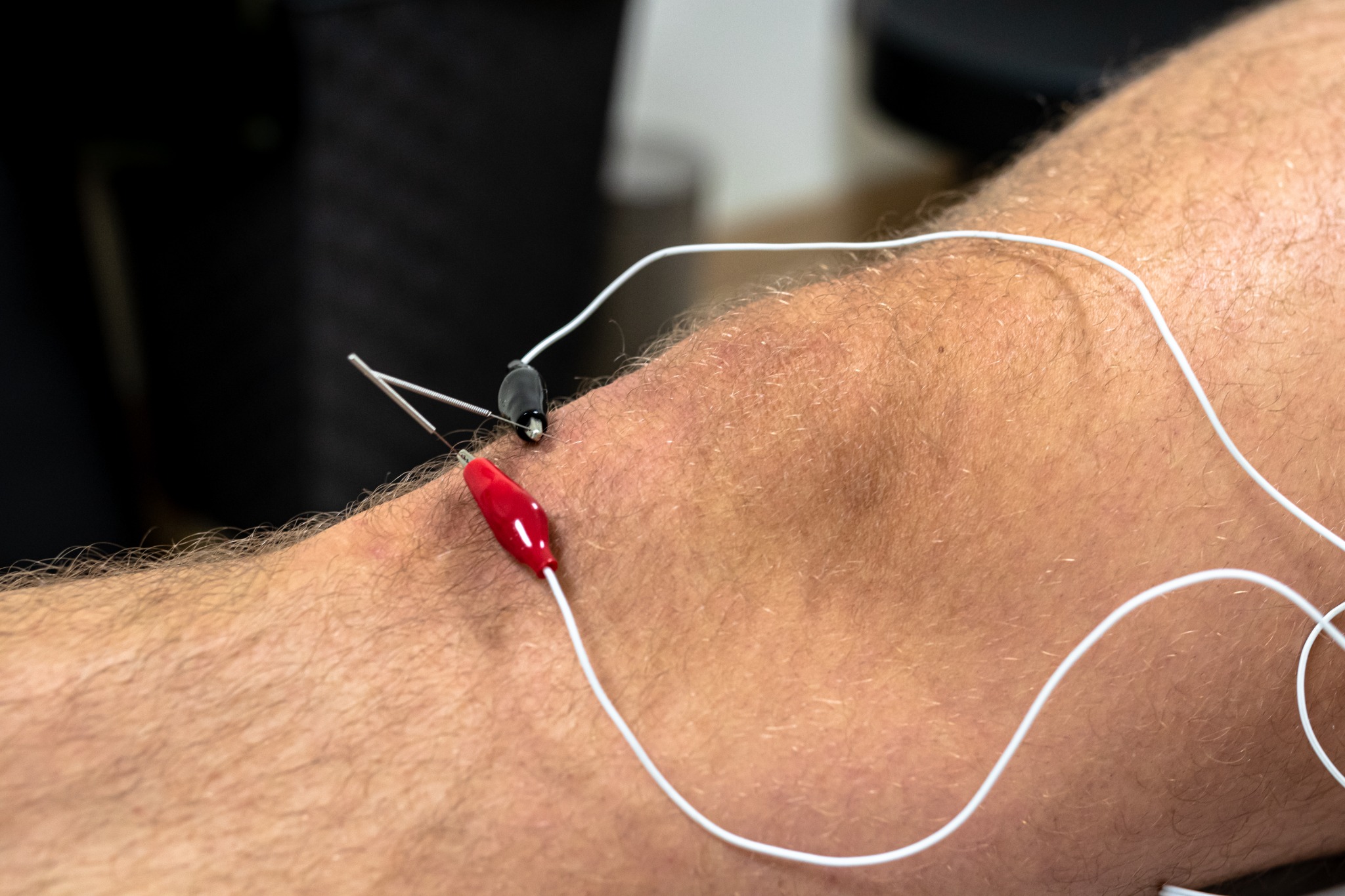 Tratamiento con punción